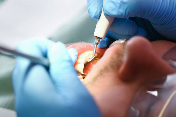 Best Chipped Tooth Repair Near Me  in Velva, ND
